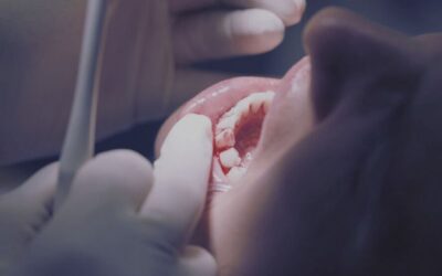 Zánět dásní (gingivitida)