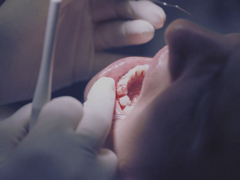 Zánět dásní (gingivitida)
