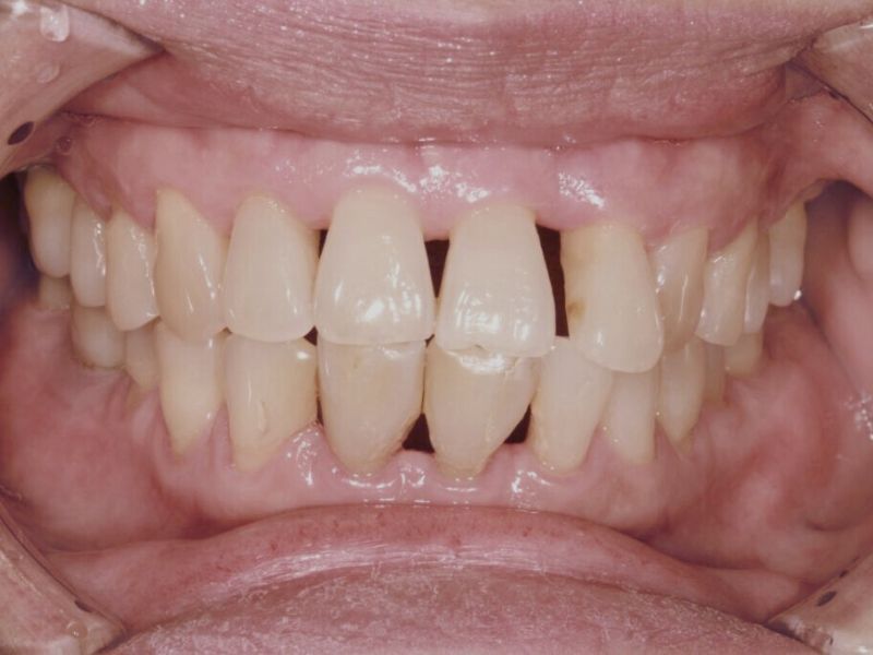 Paradentóza (parodontitida)